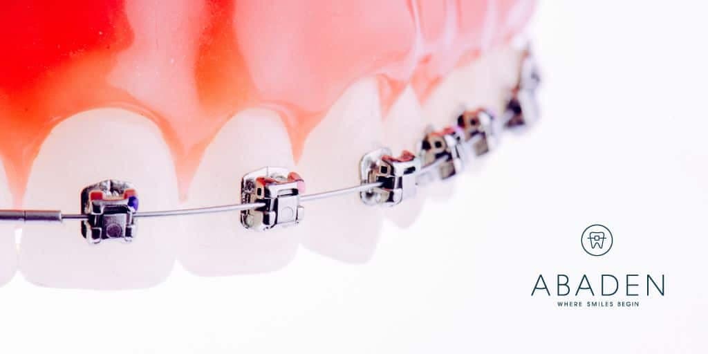 Fases de la ortodoncia: ¿cuáles son y cuánto dura cada una?