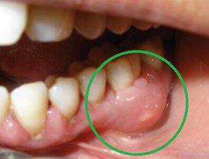 flemón dental