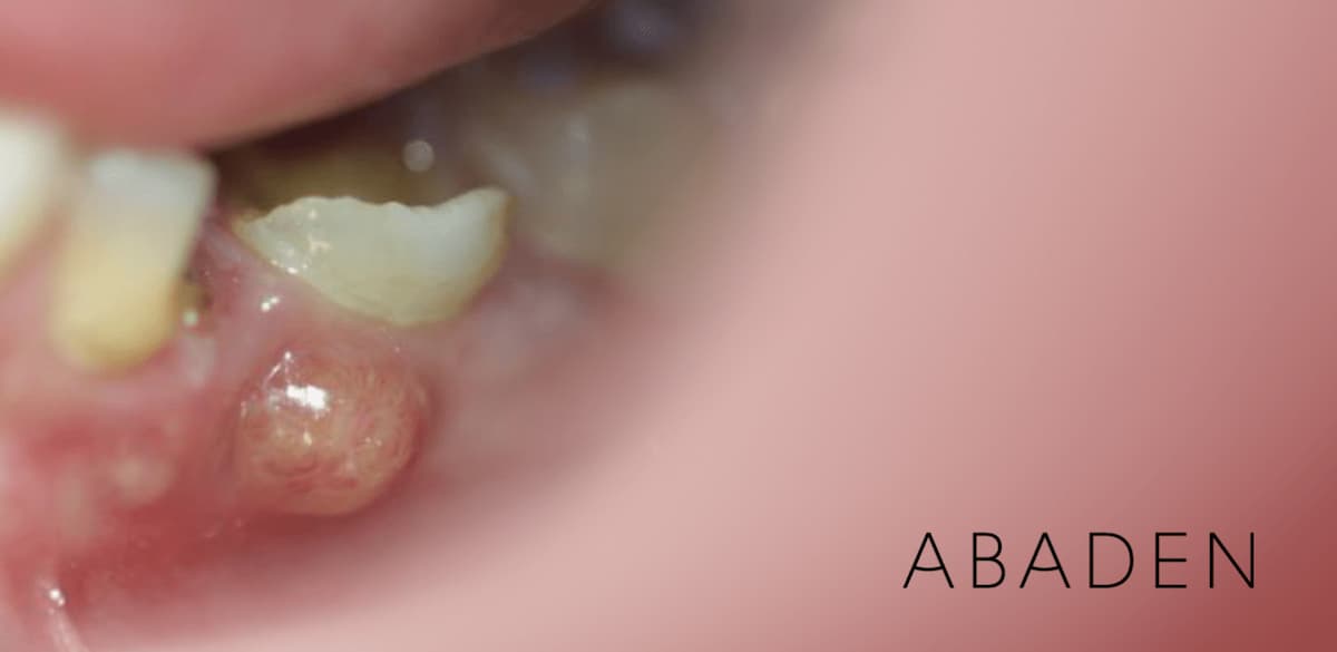 Flemón dental: ¿por qué sale? ¿Cómo se cura?