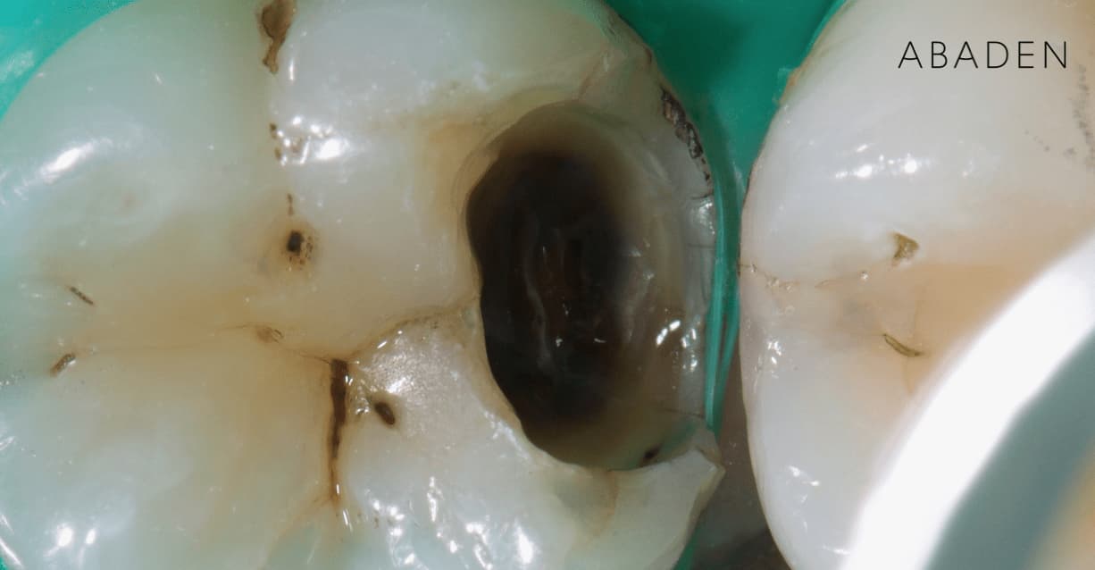 Qué es una caries dental