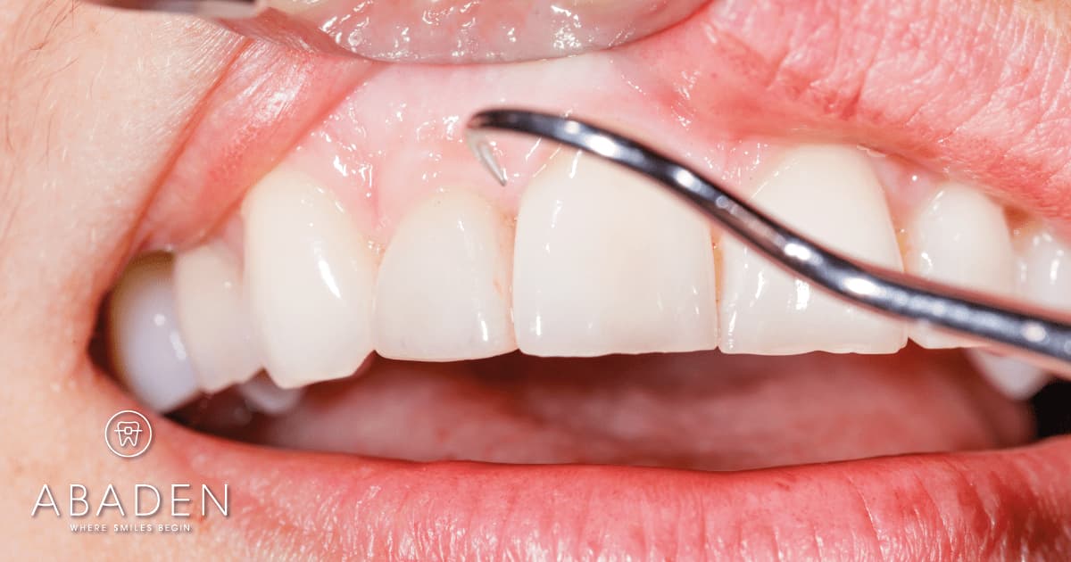 ¿Qué es un periodoncista y qué tratamientos hace? ¿Cuándo debo acudir a él?
