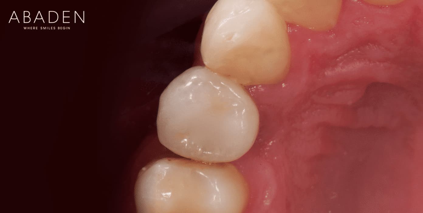 Fundas dentales ¿Cuáles son las mejores?