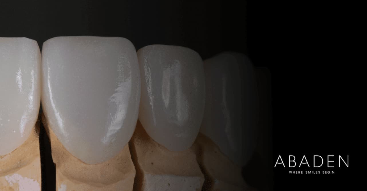 ¿Qué son las fundas de zirconio? ¿Son mejores que las de porcelana?