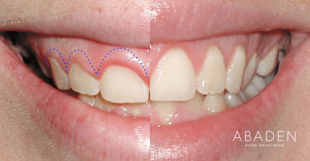 Gingivectomía: ¿Qué es y en qué casos se debe hacer?