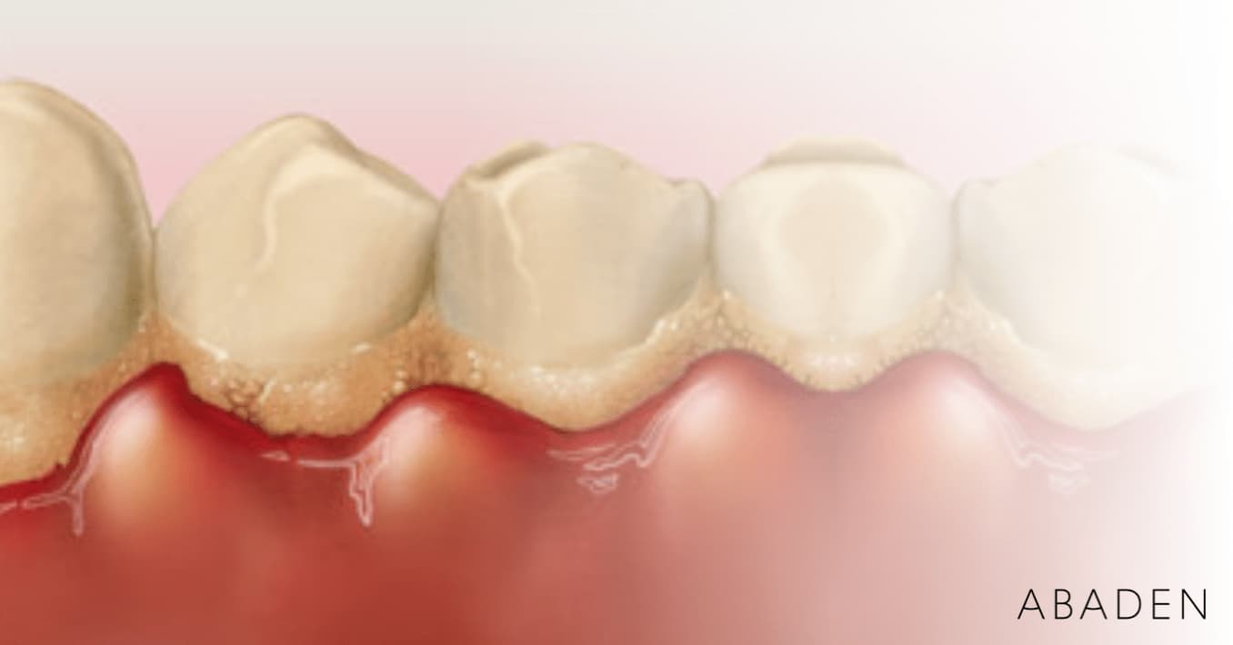 ¿Cuál es el mejor tratamiento para la gingivitis? ¿Cuánto tiempo tarda en curar?