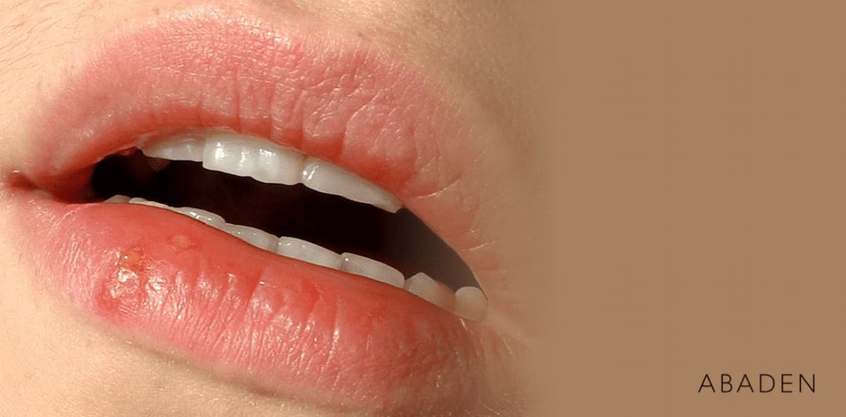 Fases del herpes labial: ¿cómo evolucionan las distintas etapas?