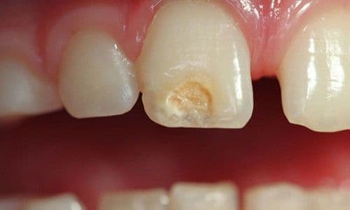Hipoplasia dental: causas y tratamiento
