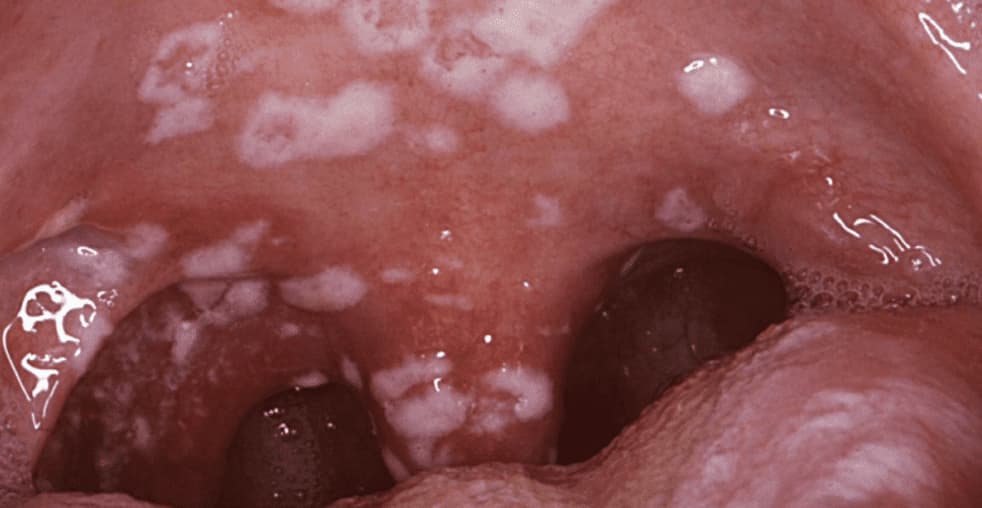 Hongos en la boca: síntomas, causas y tratamiento