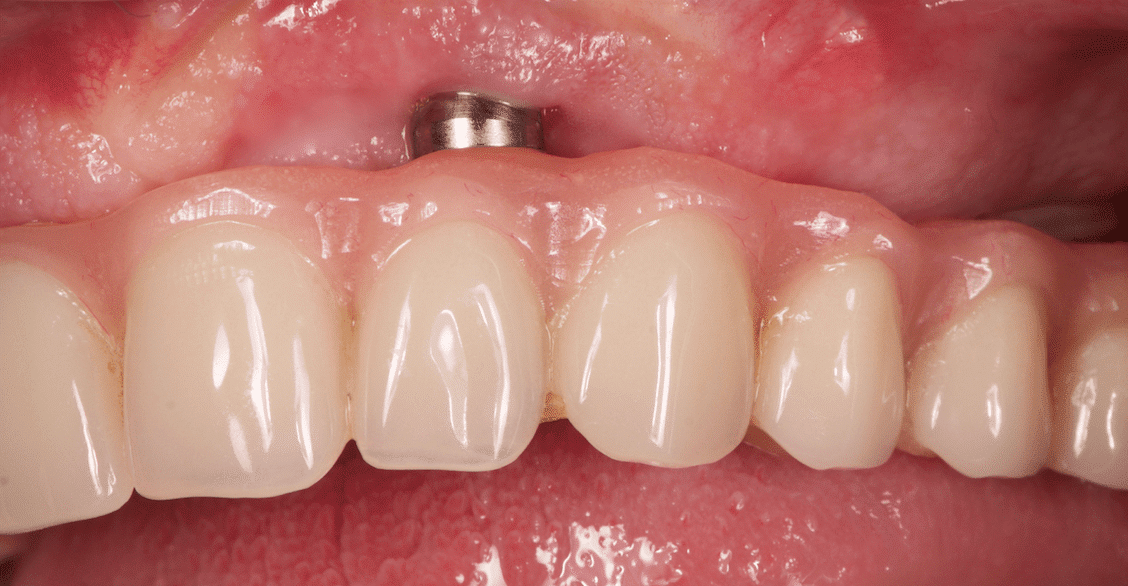 Implantes dentales – Movilidad, visibilidad o rotura de un implante