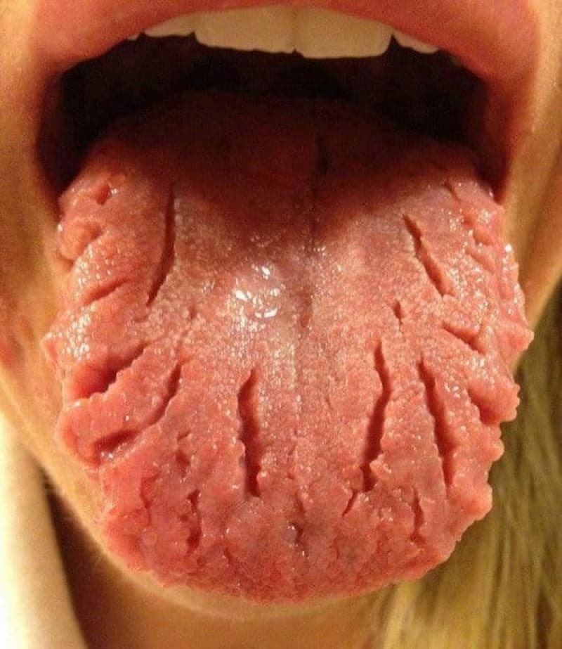 Lengua fisurada: causas y tratamientos