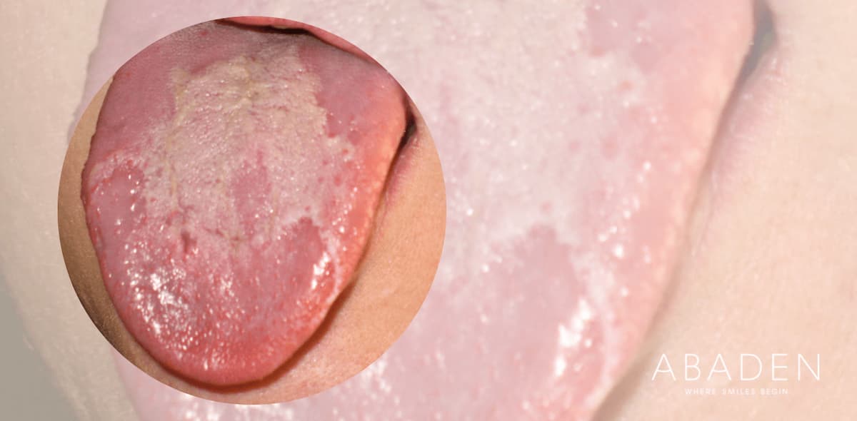 ¿Qué significa tener la lengua geográfica? ¿Cómo se cura?