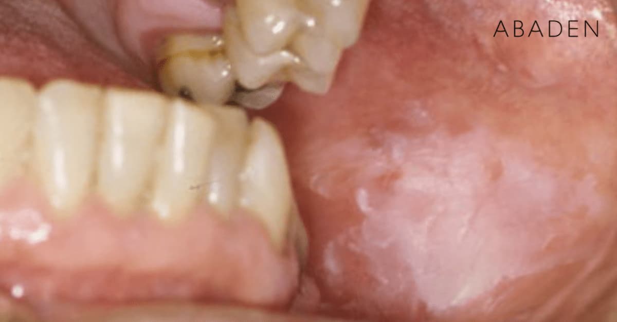 ¿Qué es la leucoplasia oral? ¿Qué causas la provocan?
