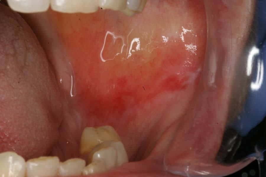 Liquen plano oral: ¿qué lo provoca? ¿Cuál es su tratamiento?