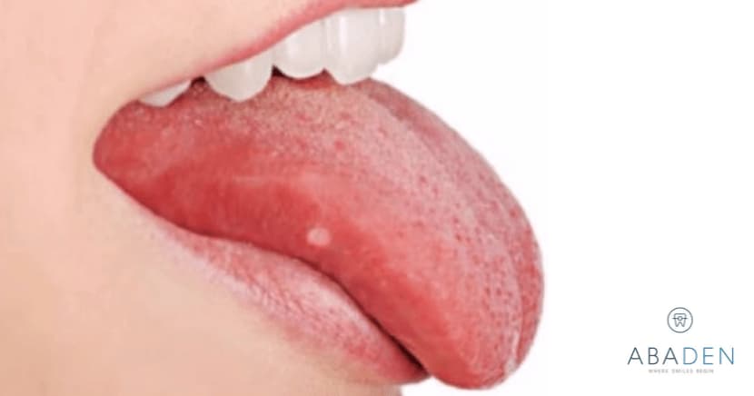 ¿Cómo curar las llagas en la lengua? ¿Existen remedios caseros?