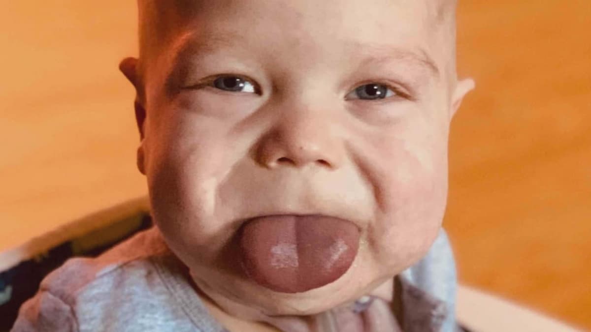 ¿Qué es la macroglosia? ¿Cómo saber si mi hijo tiene este trastorno?