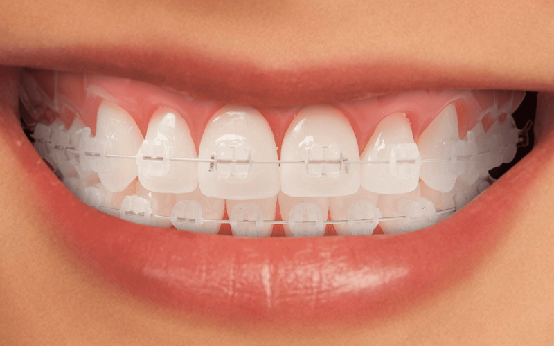 Qué son los brackets transparentes de zafiro