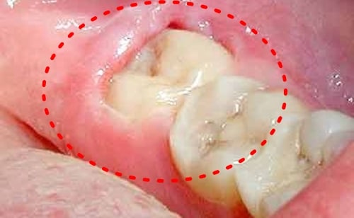 pericoronitis