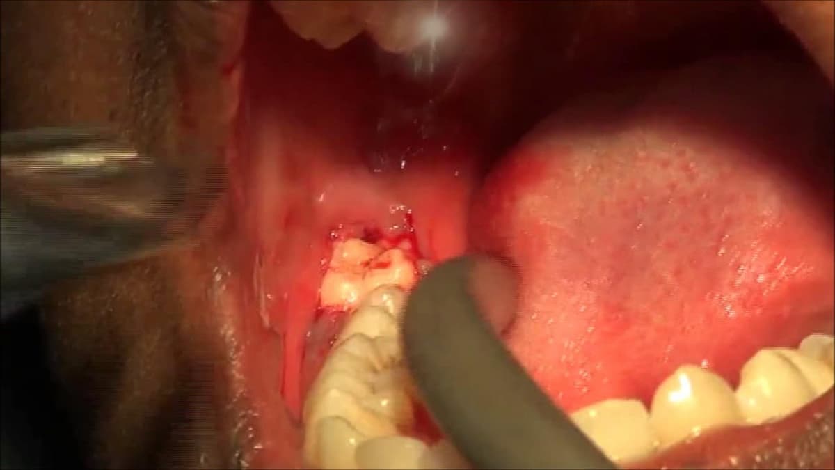 ¿Qué es la pericoronitis y cómo se cura?