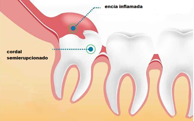 pericoronitis