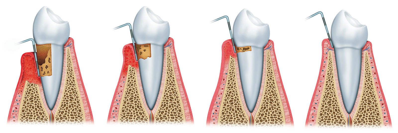 precio curetaje dental