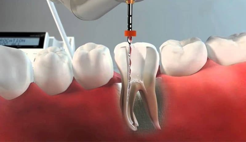 ¿Cuál es el precio de una endodoncia? Comparativa de cuánto cuesta en Sanitas, Asisa o Adeslas
