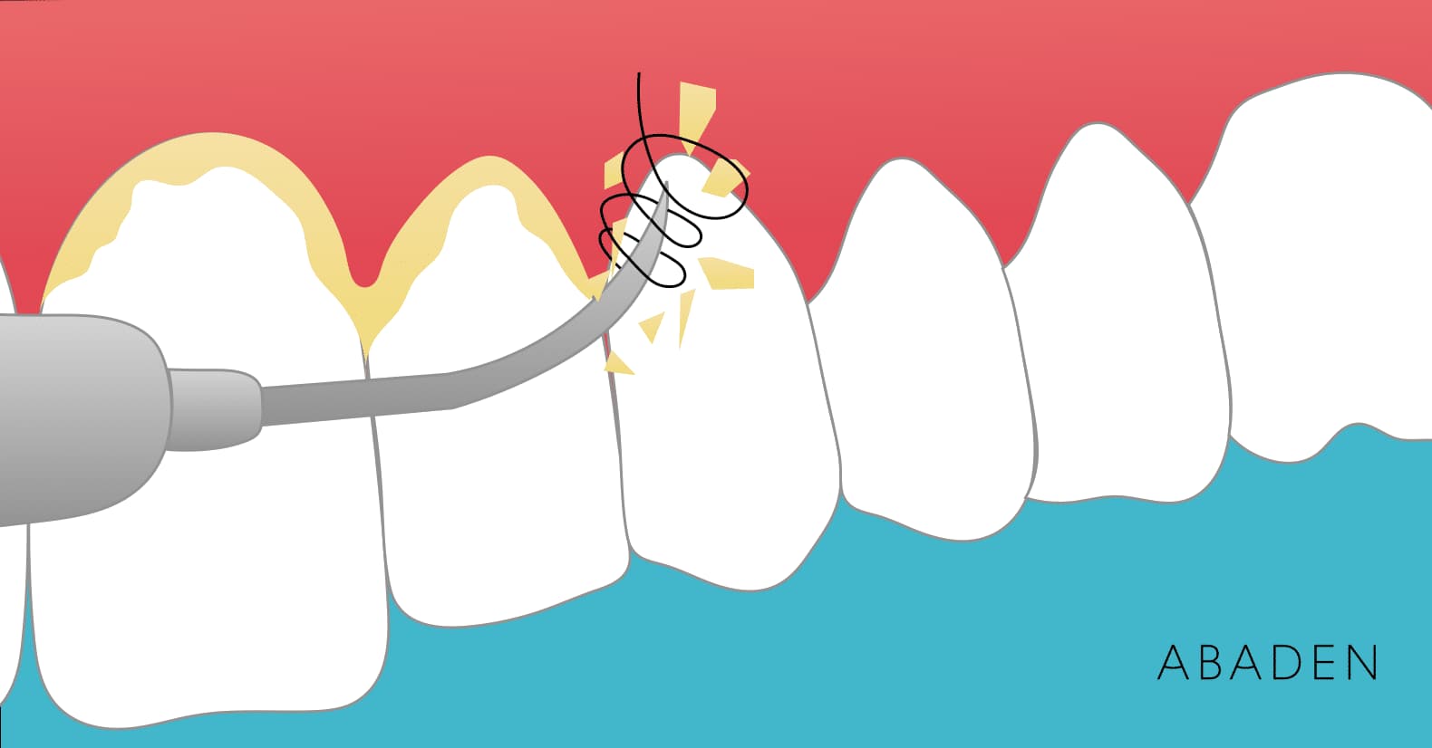 Profilaxis dental: ¿qué es y para qué sirve?