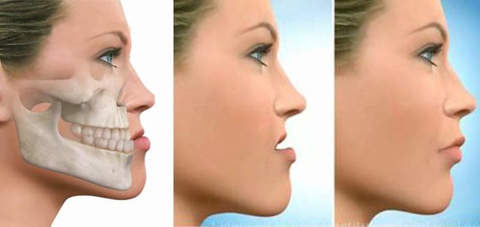 Prognatismo mandibular: causas y tratamientos para corregirlo