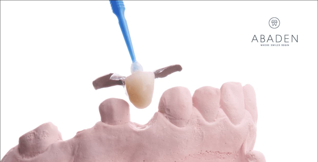 Prótesis dental info: todo lo que necesitas saber