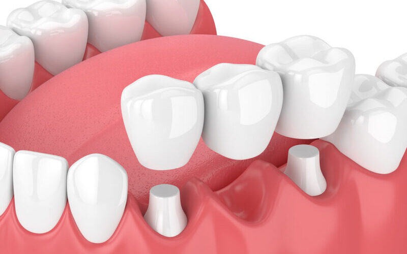 Puente dental sobre dientes o implantes