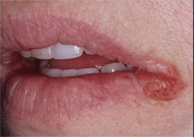 ¿Cómo curar la queilitis angular? ¿Cuánto tiempo dura?
