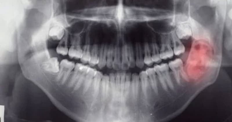 ¿Qué es un quiste odontogénico?