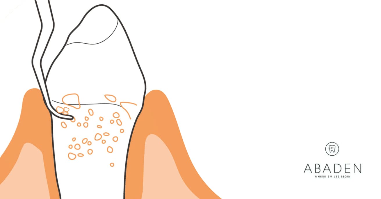 Raspado y alisado radicular ¿Qué es?