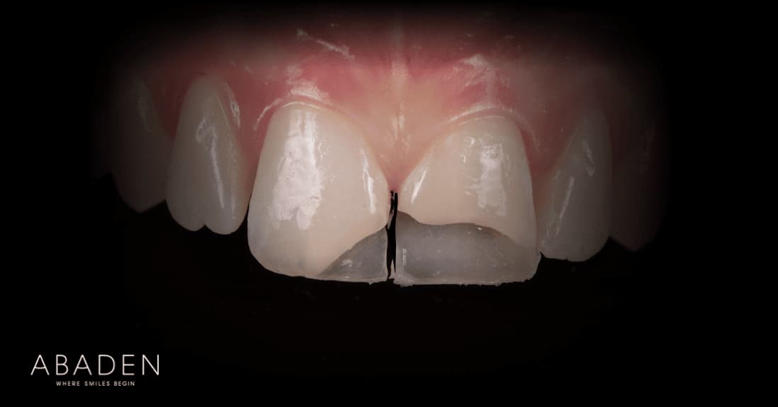 Cómo es una reconstrucción dental