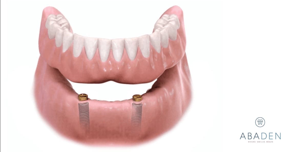 Sobredentadura sobre implantes dentales: ¿Qué ventajas tiene? ¿Cuál es su precio?