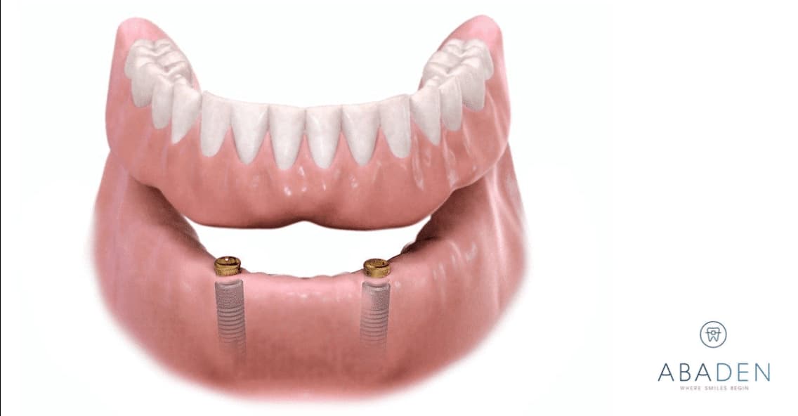 barril Ondular Ninguna Ventajas de la sobredentadura sobre implantes | Abaden