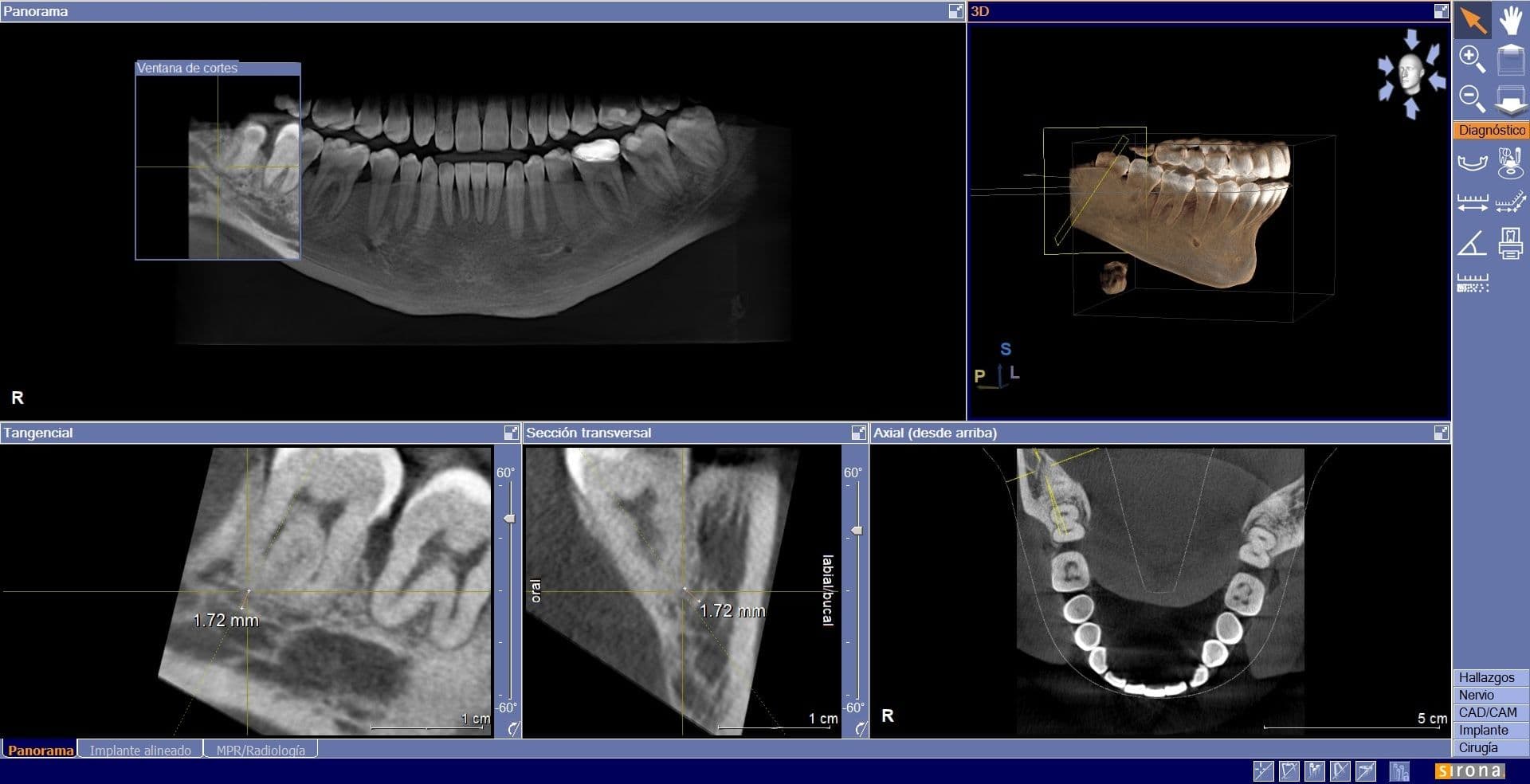 Cómo es un Tac Dental