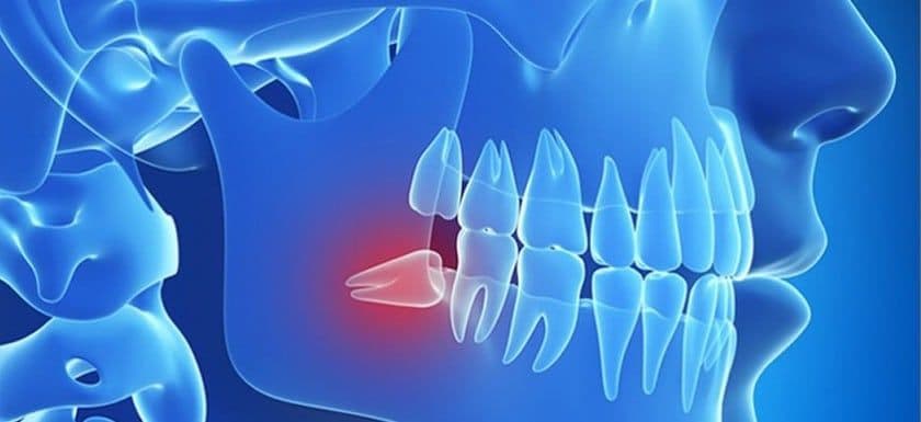 Procedimientos y tipos de exodoncia