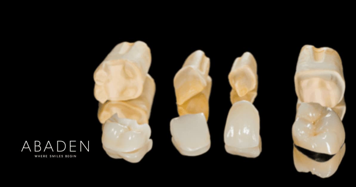 Tipos de incrustación dental