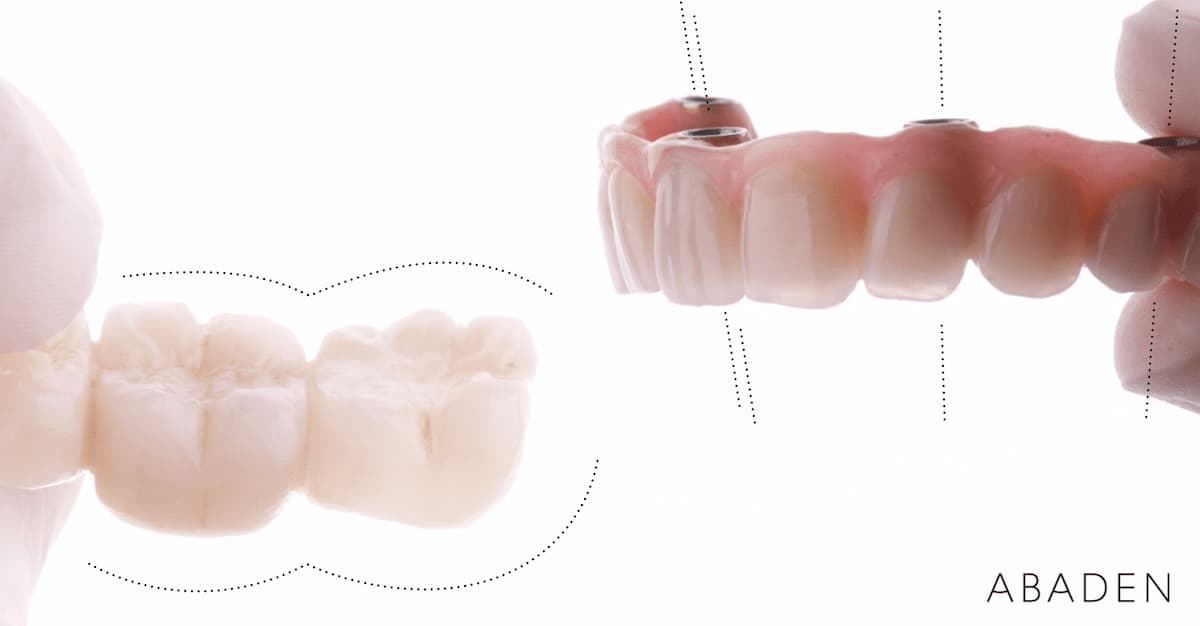 Tipos de prótesis dentales fijas