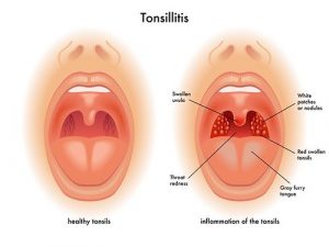 tonsilolitos