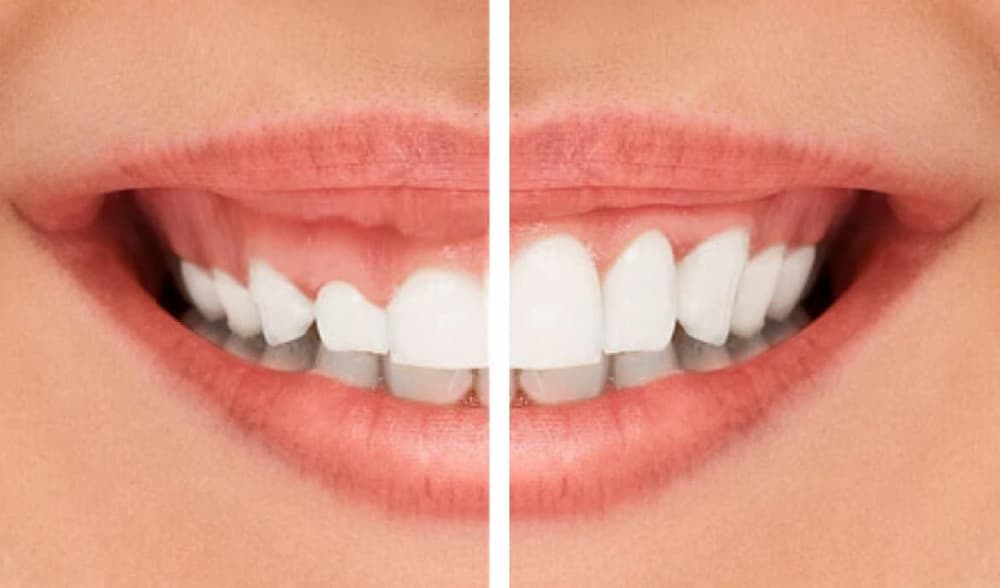 Gingivoplastia: un tratamiento seguro y efectivo para eliminar el exceso de encía
