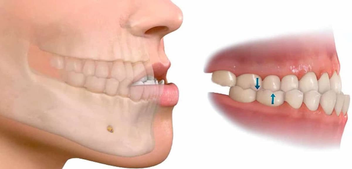 buscar En la actualidad serie Tratamiento para la mandíbula desencajada o dislocada - Abaden dentistas