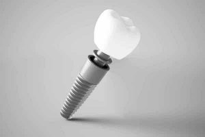 implantes dentales