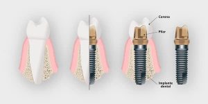 implantes dentales