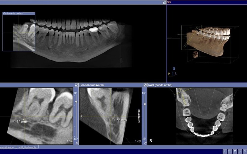 Estudio previo a la cirugía de implantes dentales