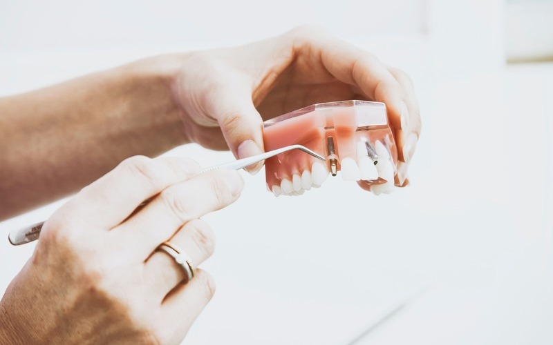 ¿Cuál es el precio de los implantes dentales?