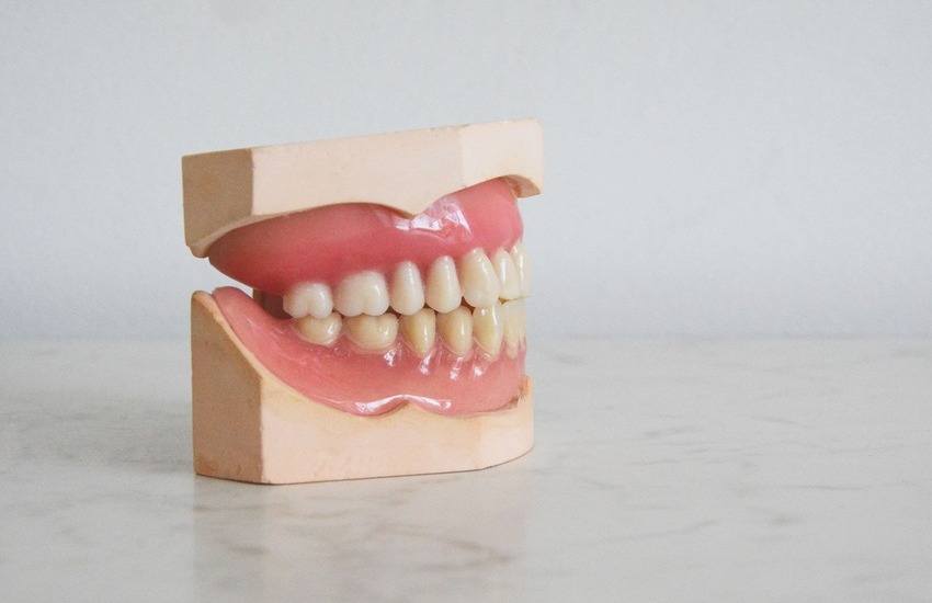 Precio de un puente dental: ¿cuánto cuesta en 2023?