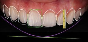 Carillas dentales de composite