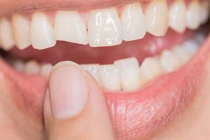 Carillas dentales de composite