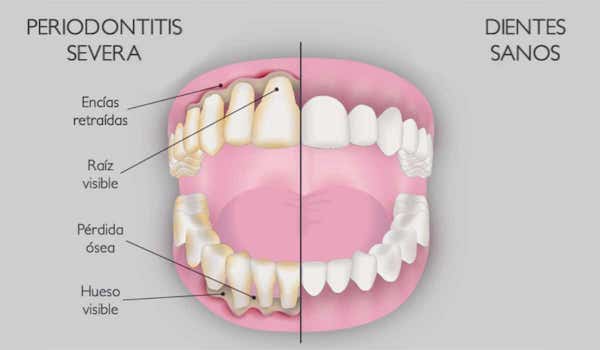 cirugia periodontal